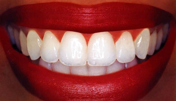 weißere zähne bekommen zahnpflege