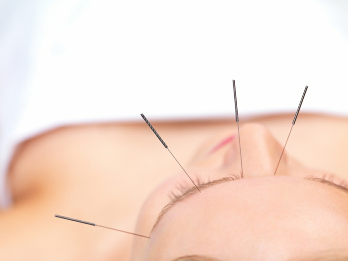 Abnehmen Akupunktur pünkte gesicht chinesische medizin