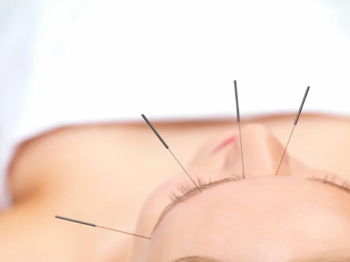 Abnehmen Akupunktur pünkte gesicht chinesische medizin
