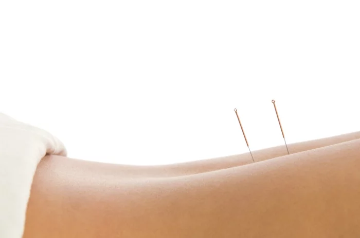 Abnehmen Akupunktur tipps tricks wirbelsäule pünkte