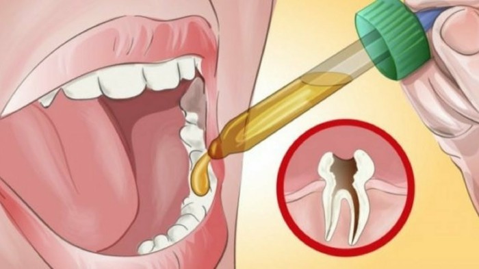 hausmittel gegen zahnschmerzen nelkenoel