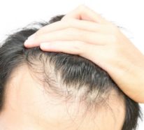 Was hilft gegen Haarausfall – die wichtigsten Methoden und Alternativen