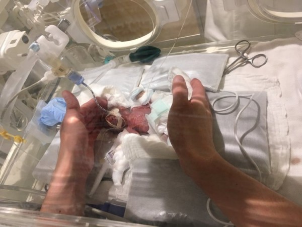 Kleinste Baby der Welt, das bei Geburt nur 268 Gramm wog, geht nach Hause winzig klein bei geburt intensivstation