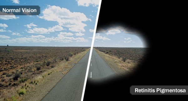 Experimentelles Implantat kann Blinden das Sehvermögen wiederherstellen retinitis pigmentosa effekte