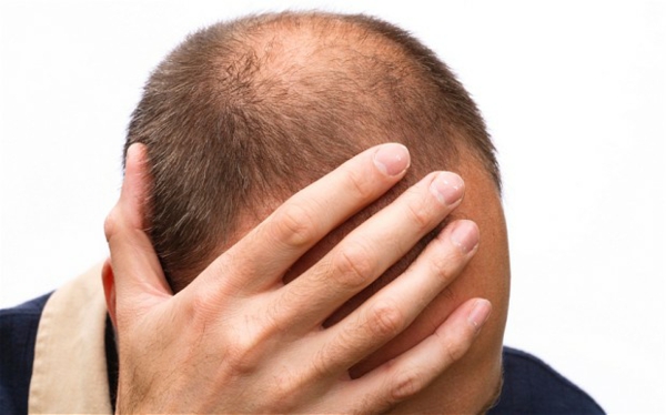 Haartransplantation Kahlköpfigkeit Männer
