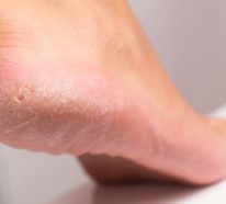 Hornhaut entfernen: Schwielen an den Füßen behandeln