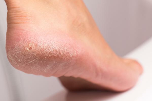 Hornhaut entfernen Schwielen Füße behandeln