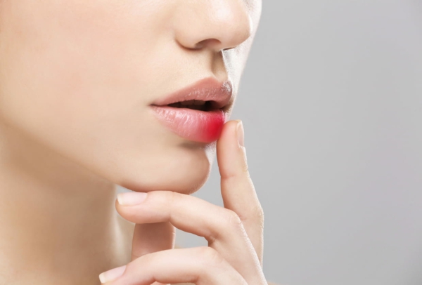 Lippenherpes Hausmittel Was hilft gegen Fieberbläschen