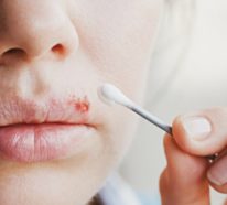 Lippenherpes Hausmittel: Was hilft gegen Fieberbläschen an der Lippe?