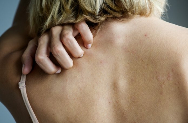 Was hilft gegen Juckreiz jukende Haut Körper Rücken