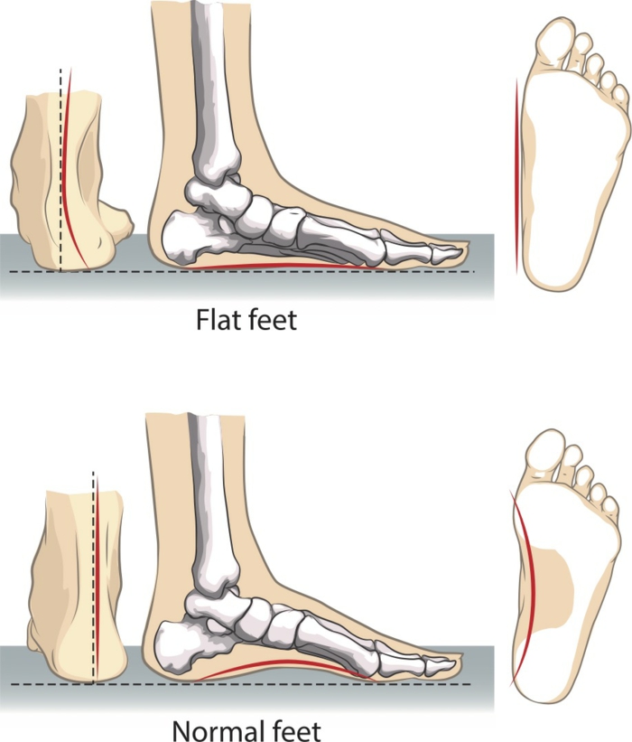  τα επίπεδα πόδια ασκούν διόρθωση της θεραπείας με επίπεδη πόδια 