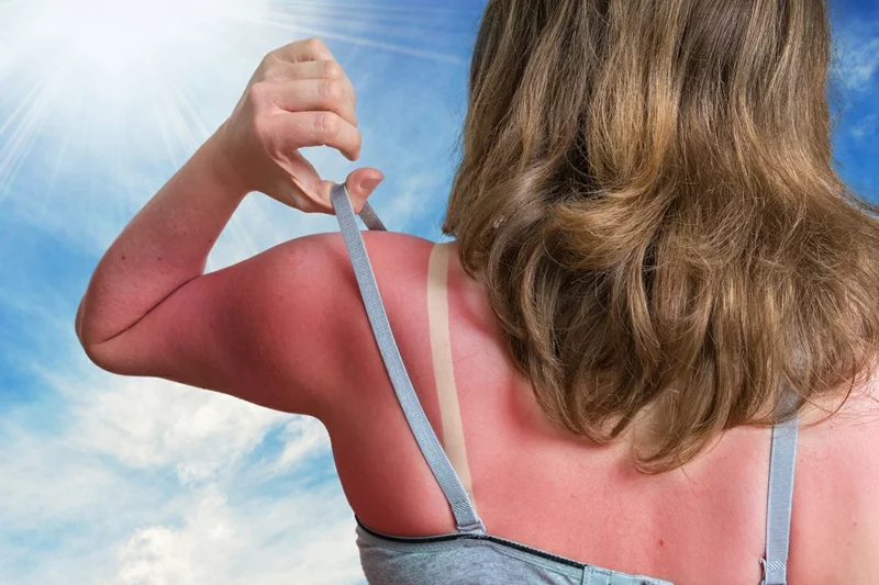 Sonnenbrand Vorbeugen 8 Nützliche Tipps Für Gesunden Teint