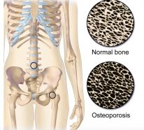 Ernährung bei Osteoporose: Was ist dabei wichtig?
