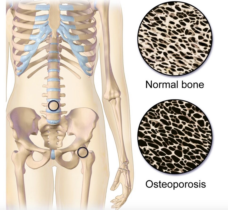 Ernährung bei Osteoporose Knochen Gesundheit