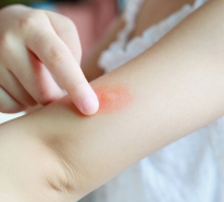 Mückenstiche – 5 Hausmittel lindern Juckreiz und Schwellung